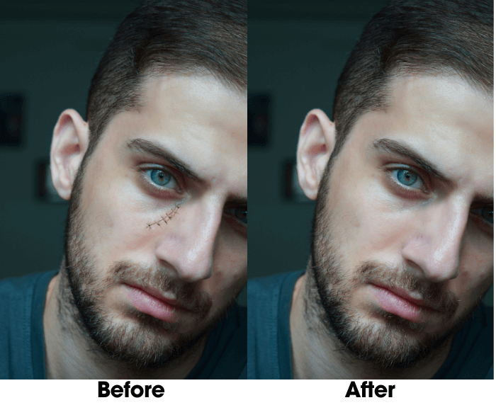 How to Remove Acne From Photos with AI Blemish Remover